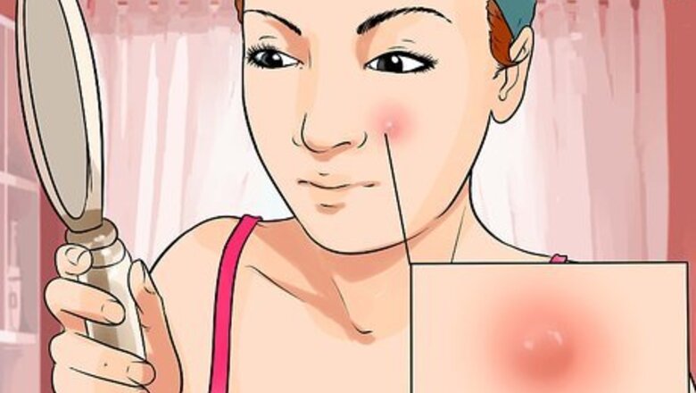 How to Pop a Boil