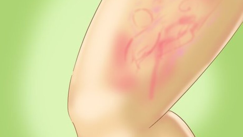 How to Recognize Hives (Urticaria)