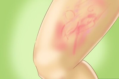 How to Recognize Hives (Urticaria)