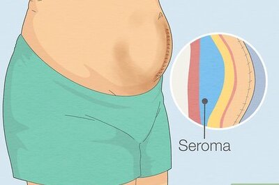 What Are Seromas? Home Remedies, Risk Factors & When to See a Doctor