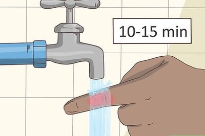 How to Treat a Blistering Burn on Your Finger