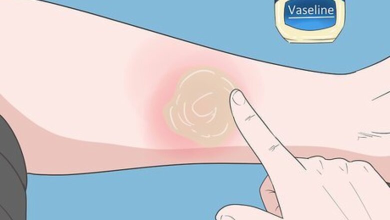 How to Cover Cellulitis