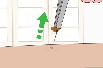 How to Reduce Bug Bite Swelling