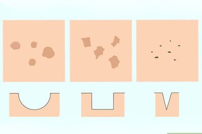 How to Get Rid of Acne Scars Fast