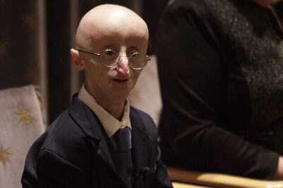 17-year-old Sam Berns battling with aging disease Progeria, dies