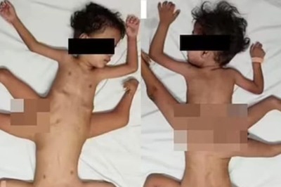 In Indonesia, Rare 'Spider' Twins With Three Legs, Four Arms And A Fused Pelvis, Spotted