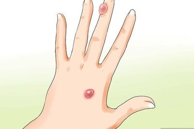 How to Treat an Infected Blister