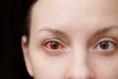 7 Easy Ways To Prevent Conjunctivitis