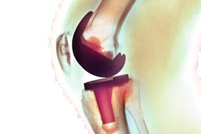 Exercise Alone May Not Protect Your Knees: Study