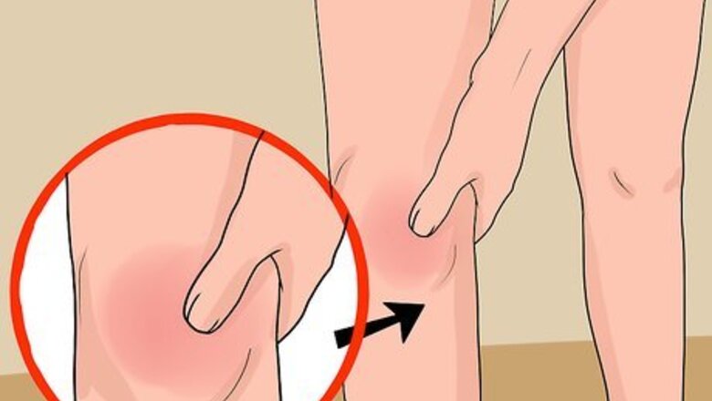 How to Treat a Swollen Knee