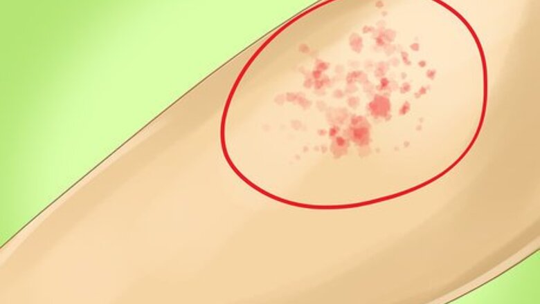 How to Identify Measles
