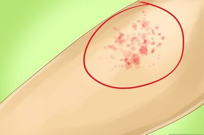 How to Identify Measles