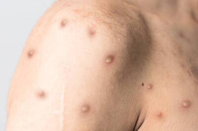 What Is Monkeypox? Here’s How to Prevent Your Child From Getting Infected