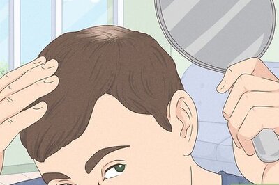 How to Know if You Have Male Pattern Baldness