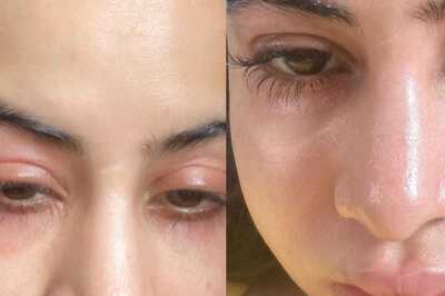 Urfi Javed, After Sharing Photo Of Her Swollen Face, Asks 'Will I Ever Get Okay'