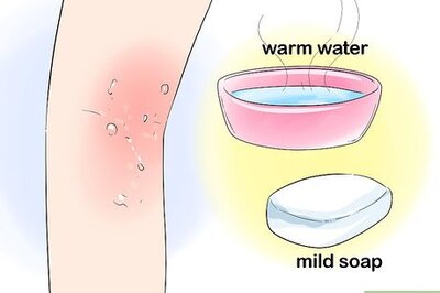 How to Treat Chafing