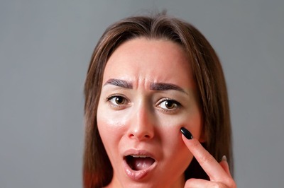 Sunburn or Suntan: Which is More Harmful? Know From Expert