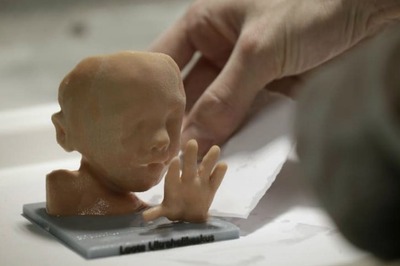 Underdeveloped Foetus Found in Infant Girl's Abdomen in Chhattisgarh