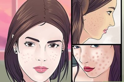 How to Prevent Acne Scars