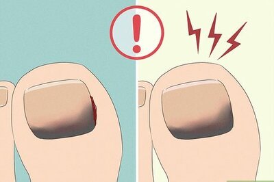 How to Treat a Black Toenail from Injury, Fungus, & More