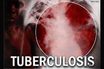 WHO verifies new 100-minTB diagnostic test