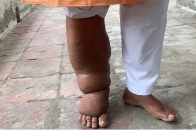 From Snake Oils, Scorpion Bites to Medicines & Awareness: A Look at India's Fight Against Elephantiasis