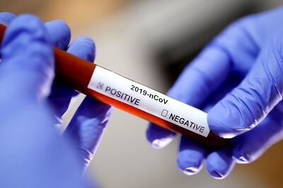 US Confirmed Coronavirus Cases Cross 100,000, Shows Tracker