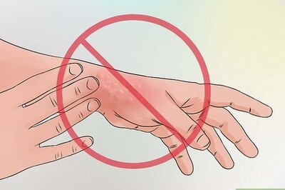 How to Treat a Sting from a Stinging Nettle