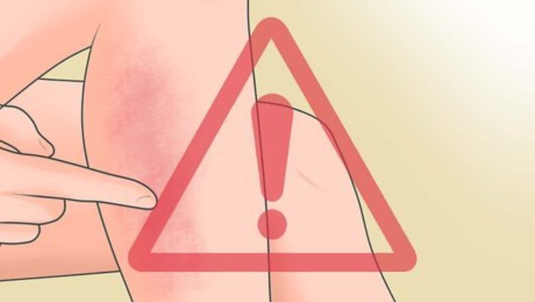 How to Spot Contact Dermatitis Symptoms
