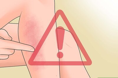 How to Spot Contact Dermatitis Symptoms