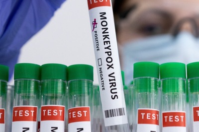 Delhi's First Monkeypox Patient Discharged from Hospital; 2nd Delhi Patient Stable