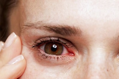 Eye Care Mistakes to Avoid During the Rainy Season to Prevent Conjunctivitis